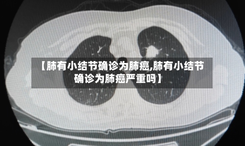 【肺有小结节确诊为肺癌,肺有小结节确诊为肺癌严重吗】-第2张图片