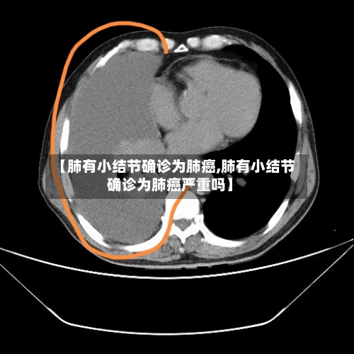 【肺有小结节确诊为肺癌,肺有小结节确诊为肺癌严重吗】-第3张图片