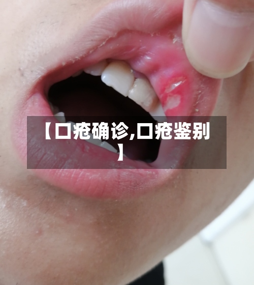 【口疮确诊,口疮鉴别】-第2张图片