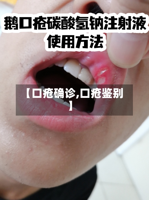 【口疮确诊,口疮鉴别】-第3张图片