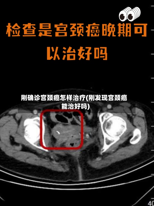 刚确诊宫颈癌怎样治疗(刚发现宫颈癌能治好吗)