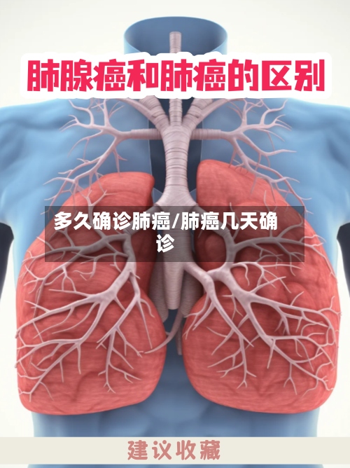多久确诊肺癌/肺癌几天确诊