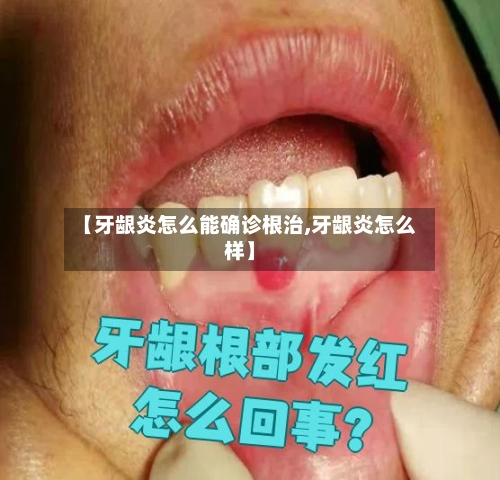 【牙龈炎怎么能确诊根治,牙龈炎怎么样】