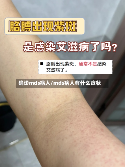 确诊mds病人/mds病人有什么症状-第3张图片