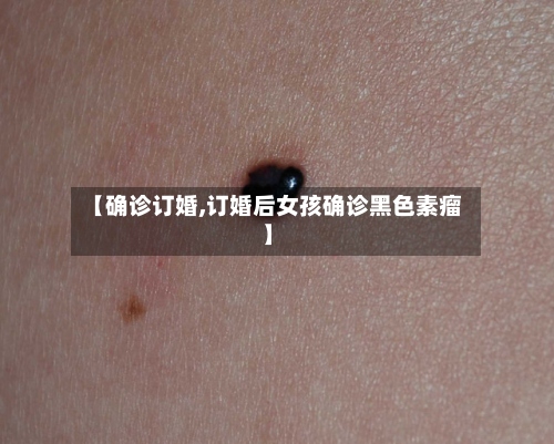 【确诊订婚,订婚后女孩确诊黑色素瘤】