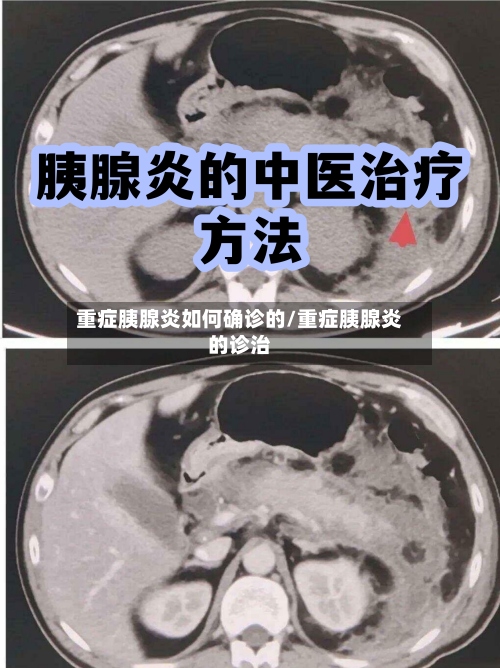 重症胰腺炎如何确诊的/重症胰腺炎的诊治