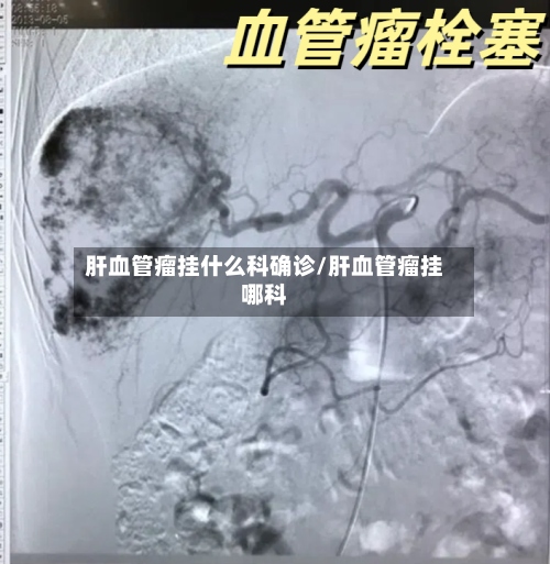 肝血管瘤挂什么科确诊/肝血管瘤挂哪科-第2张图片