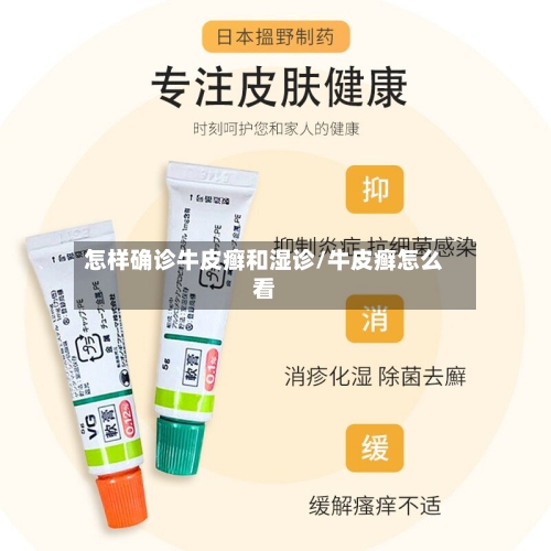 怎样确诊牛皮癣和湿诊/牛皮癣怎么看-第2张图片