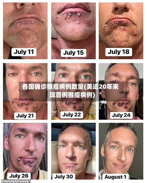 各国确诊猴痘病例数量(美近20年来现首例猴痘病例)