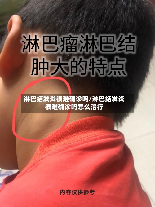 淋巴结发炎很难确诊吗/淋巴结发炎很难确诊吗怎么治疗-第2张图片