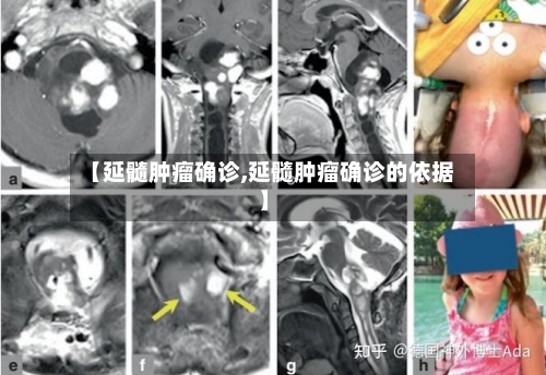 【延髓肿瘤确诊,延髓肿瘤确诊的依据】-第2张图片