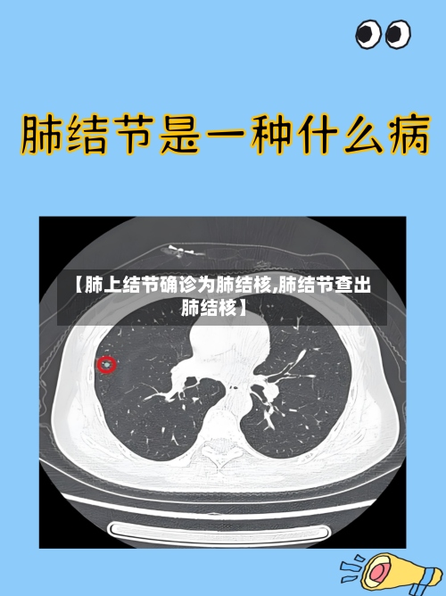 【肺上结节确诊为肺结核,肺结节查出肺结核】-第3张图片