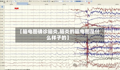 【脑电图确诊脑炎,脑炎的脑电图是什么样子的】