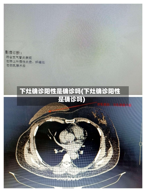 下灶确诊阳性是确诊吗(下灶确诊阳性是确诊吗)