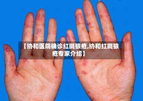 【协和医院确诊红斑狼疮,协和红斑狼疮专家介绍】
