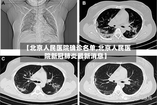 【北京人民医院确诊名单,北京人民医院新冠肺炎最新消息】
