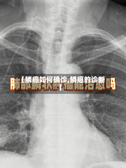 【鳞癌如何确诊,鳞癌的诊断】-第3张图片