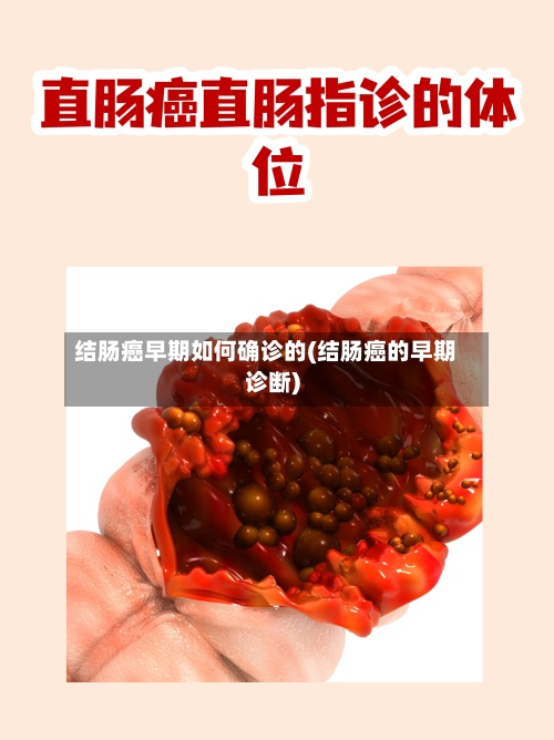 结肠癌早期如何确诊的(结肠癌的早期诊断)