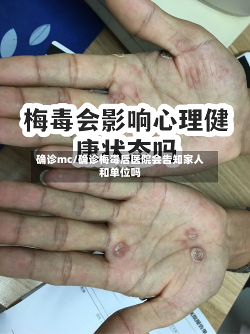 确诊mc/确诊梅毒后医院会告知家人和单位吗-第2张图片