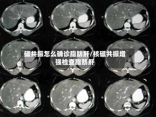 磁共振怎么确诊脂肪肝/核磁共振增强检查脂肪肝