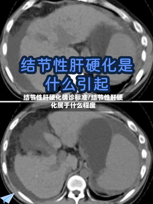 结节性肝硬化确诊标准/结节性肝硬化属于什么程度