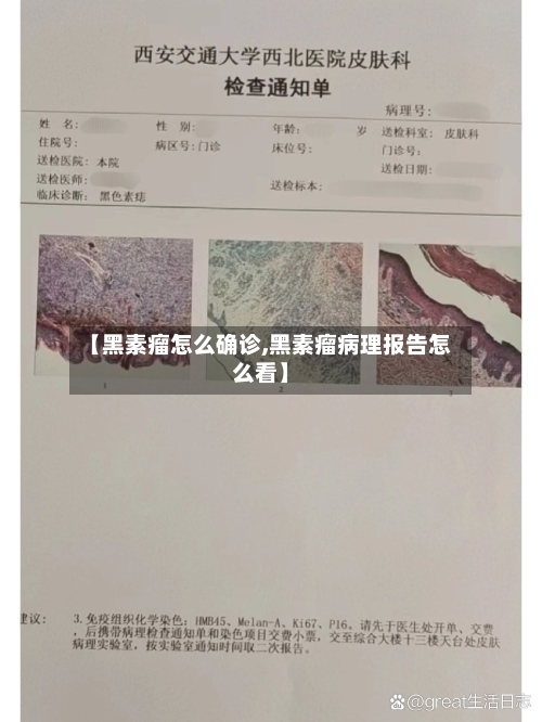 【黑素瘤怎么确诊,黑素瘤病理报告怎么看】