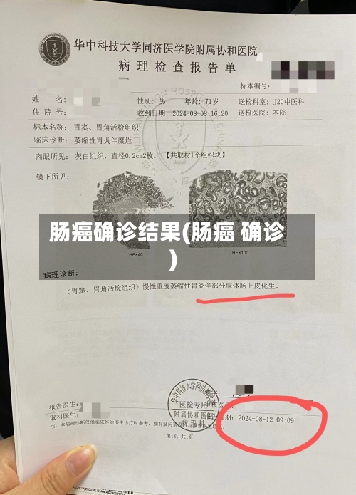 肠癌确诊结果(肠癌 确诊)-第3张图片