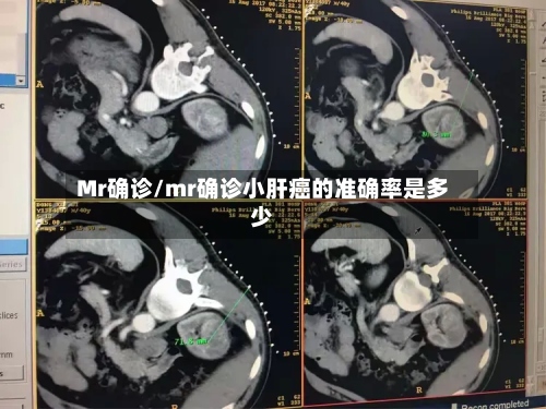 Mr确诊/mr确诊小肝癌的准确率是多少-第2张图片