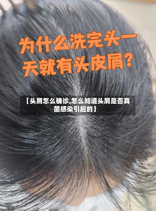 【头屑怎么确诊,怎么知道头屑是否真菌感染引起的】-第2张图片