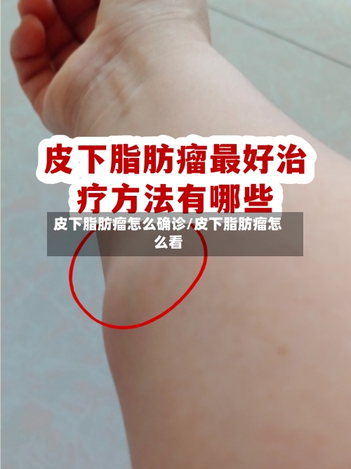 皮下脂肪瘤怎么确诊/皮下脂肪瘤怎么看