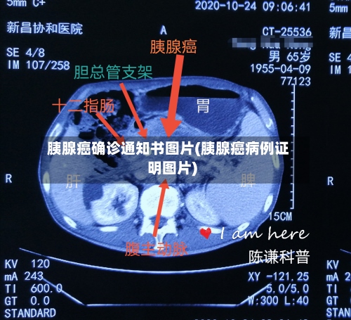 胰腺癌确诊通知书图片(胰腺癌病例证明图片)-第2张图片