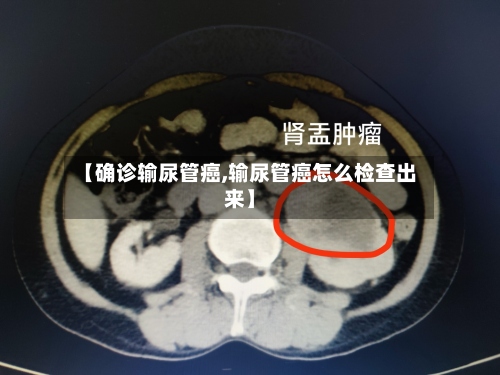 【确诊输尿管癌,输尿管癌怎么检查出来】