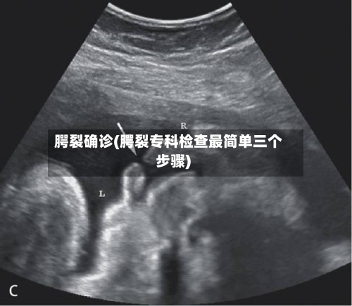 腭裂确诊(腭裂专科检查最简单三个步骤)-第2张图片