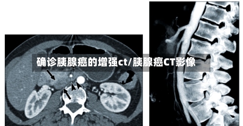 确诊胰腺癌的增强ct/胰腺癌CT影像-第2张图片