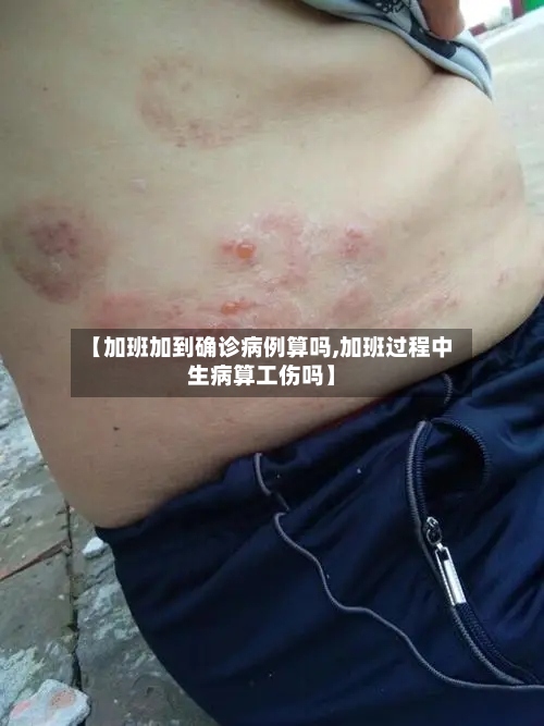【加班加到确诊病例算吗,加班过程中生病算工伤吗】-第3张图片