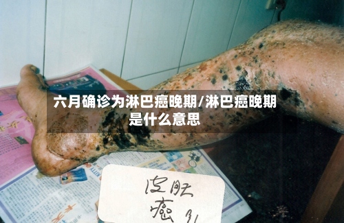 六月确诊为淋巴癌晚期/淋巴癌晚期是什么意思-第3张图片
