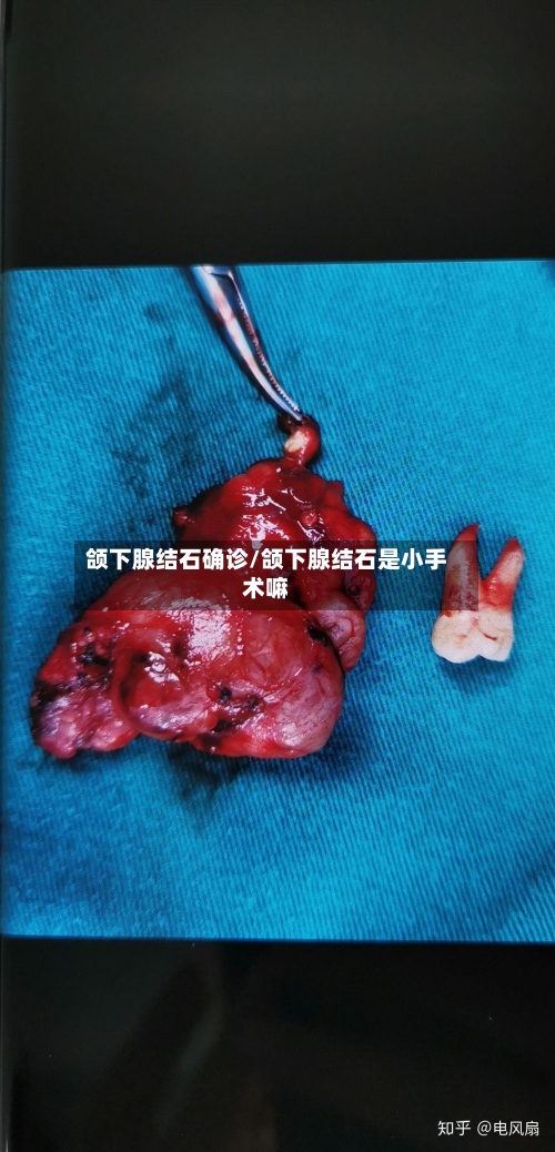 颌下腺结石确诊/颌下腺结石是小手术嘛