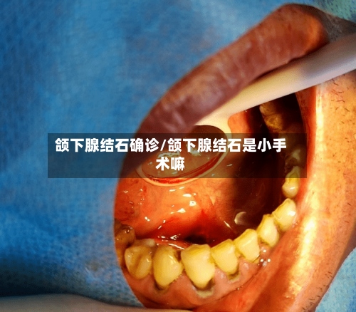颌下腺结石确诊/颌下腺结石是小手术嘛-第2张图片