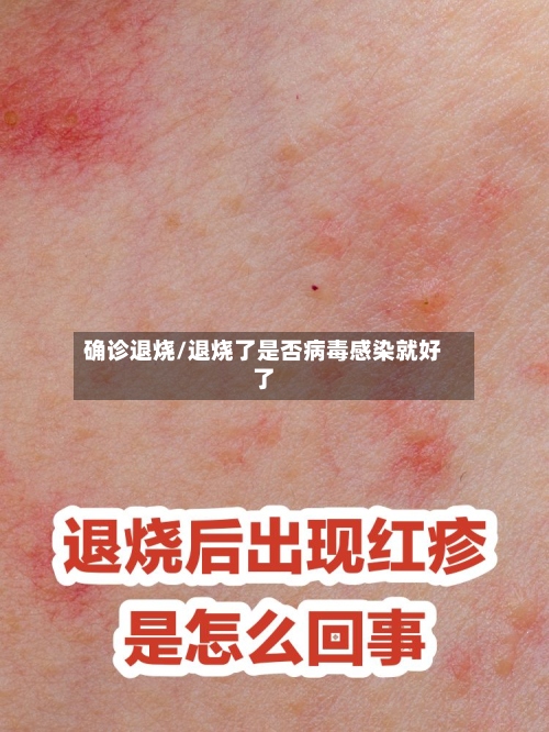 确诊退烧/退烧了是否病毒感染就好了