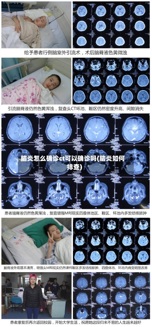 脑炎怎么确诊ct可以确诊吗(脑炎如何排查)-第2张图片
