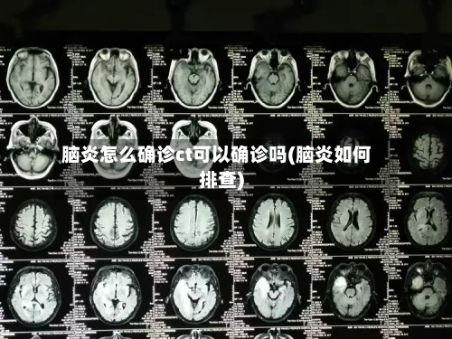 脑炎怎么确诊ct可以确诊吗(脑炎如何排查)-第3张图片