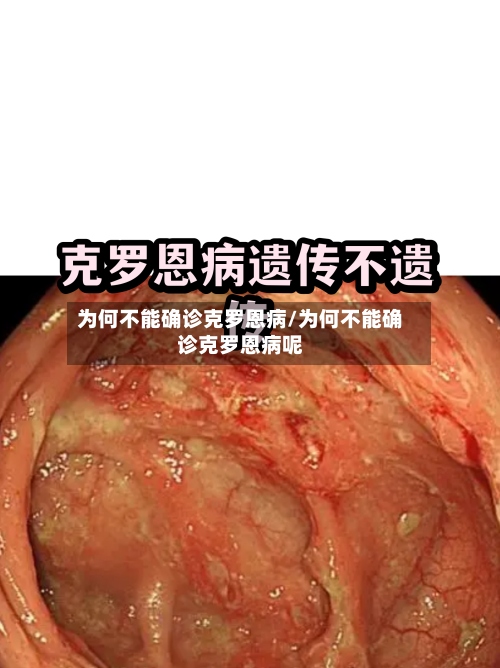 为何不能确诊克罗恩病/为何不能确诊克罗恩病呢