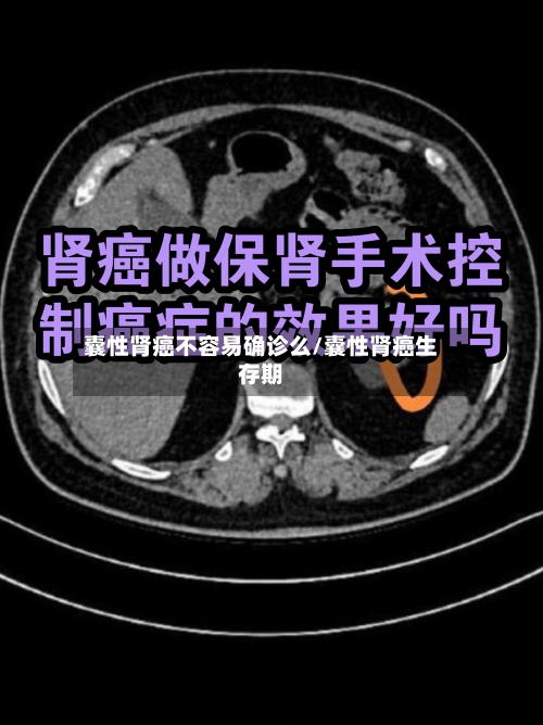 囊性肾癌不容易确诊么/囊性肾癌生存期-第2张图片