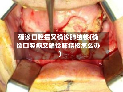 确诊口腔癌又确诊肺结核(确诊口腔癌又确诊肺结核怎么办)