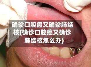 确诊口腔癌又确诊肺结核(确诊口腔癌又确诊肺结核怎么办)-第3张图片