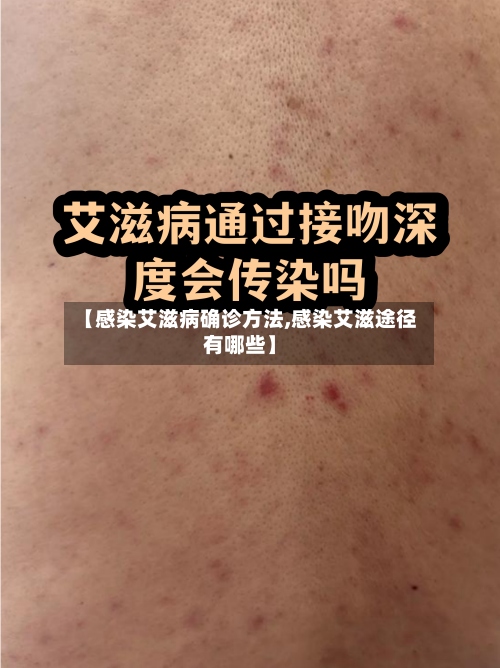【感染艾滋病确诊方法,感染艾滋途径有哪些】-第2张图片
