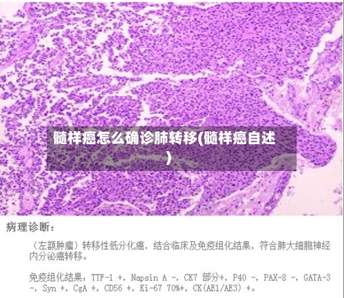 髓样癌怎么确诊肺转移(髓样癌自述)