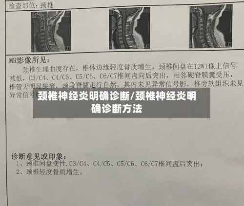 颈椎神经炎明确诊断/颈椎神经炎明确诊断方法