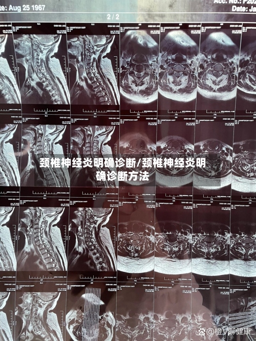 颈椎神经炎明确诊断/颈椎神经炎明确诊断方法-第2张图片