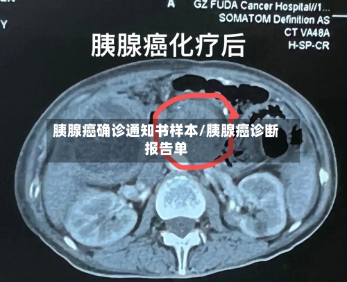 胰腺癌确诊通知书样本/胰腺癌诊断报告单-第2张图片